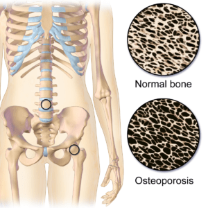 Osteoporosis Locations.png